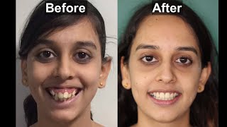 BRACES  before and after  BEST SMILE TRANSFORMATION  Gummy smile  smile design  mini implants [upl. by Melloney218]