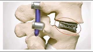 Deciding Optimal Cages for Trans Foraminal Lumbar Interbody Fusion TLIF [upl. by Eadrahc]