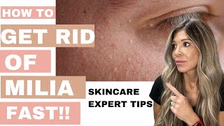 How to get rid of Milia FAST 2024 Smooth Skin Secrets Master Esthetician Milia Removal Tips [upl. by Oznecniv648]