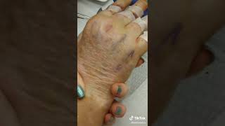 Hand reconstructive surgery removing stitches video 3 [upl. by Niwde360]