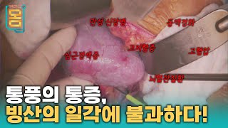 Full 통풍의 통증 빙산의 일각에 불과하다ㅣ귀하신 몸ㅣ54화 통풍이 무서운 진짜 이유 [upl. by Adiuqram]