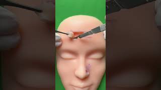 Bilateral advancement flap for forehead reconstruction flap incision part 3 Link in bio for pad [upl. by Jessamyn]