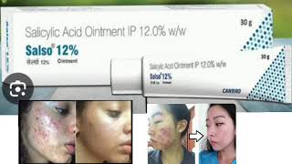 Salso 12 Ointment Salicylic Acid Ointment IP 120 ww [upl. by Skip]