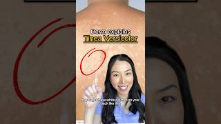 Fungal infection on the skin😱 Tinea versicolor explained shorts [upl. by Lleryd507]