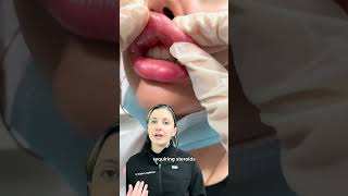 What are the risk of overfilled lip filler Dr Medispa [upl. by Suhploda613]