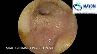 Glue Ear Otitis Media with Effusion  Treatment by Myringotomy Grommet Insertion  Dr Manish Prakash [upl. by Alleuqram642]