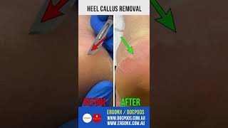 Heel Callus Removal [upl. by Risay]