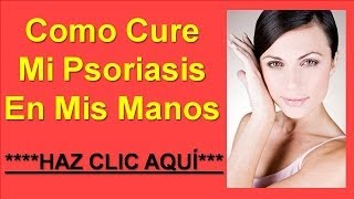 Como Curar La Psoriasis En Las Manos Con Remedios Caseros [upl. by Isbella]