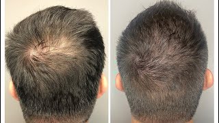 Minoxidil Conflugain Avis  Arnaque  Le Pire Minoxidil  Comment faire pousser sa barbe [upl. by Alethea784]