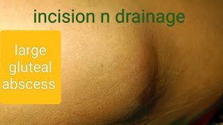 large gluteal abscess  incision n drainage dr youtube doctor [upl. by Eedahs481]