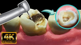 Endodoncia en muela con caries profunda  Tratamiento de conducto [upl. by Znerol878]