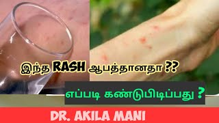 fever with rash in tamil dangerous rash glass test for rash in tamil dengue rash in tamil [upl. by Arahas]