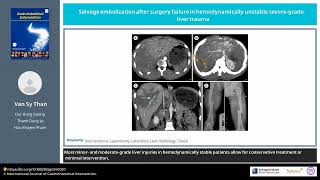 Salvage embolization after surgery failure in hemodynamically unstable severegrade liver trauma [upl. by Ingaborg]