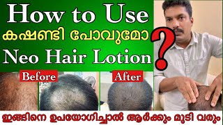 How to use Neo Hair Lotion successfully MalayalamOriginal Neo Hair Lotionഎങ്ങിനെ ഉപയോഗിക്കാം [upl. by Ardnasella]