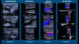 Introduction to Venous Insufficiency Exams [upl. by Galitea654]