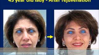 Botox amp Dermal Filler Injection Made Her Young Again  Liquid Facelift Technique [upl. by Leilani552]