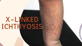 Dermatology lecture seriesGenodermatoses X linked ichthyosis [upl. by Eelahc]