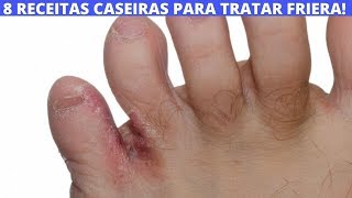 8 RECEITAS CASEIRAS PARA TRATAR FRIEIRA [upl. by Devad682]