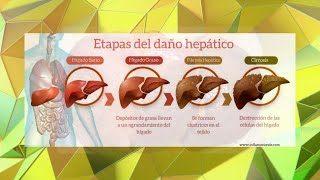 Etapas del daño por hepatomegalia ¿Qué significa el agrandamiento del hígado [upl. by Ecam891]