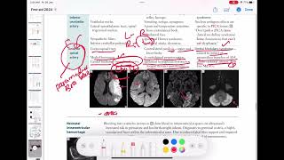 Anterior spinal artery stroke neurology 78  First Aid USMLE Step 1 in UrduHindi [upl. by Trilbee795]