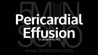 Pericardial effusion [upl. by Ellennod]