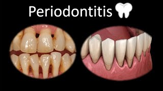 🦷 Periodontitis  Cavidad oral  Cabeza y Cuello  Patología [upl. by Seniag]