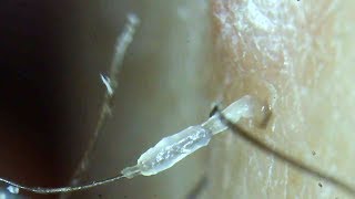 Squishy slimy ingrown hair and roots plucked under a microscope [upl. by Zilla206]