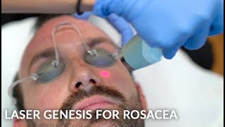 Rosacea Treatment with Laser Genesis  Live [upl. by Air]