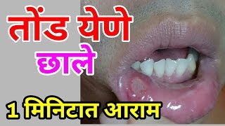 तोंड येणे 1 मिनिटात आराम घरगुती उपाय Tond yene Gharguti upay in Marathi  Mouth Ulcer Home Remedy [upl. by Ymeon]