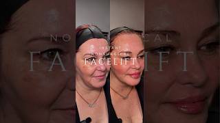 Check out the AMAZING Instant Facelift by Dolce Derm ✨ [upl. by Norris]