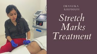 3 Best Stretch marks treatment🤩  Laser for stretch marks [upl. by Natanhoj]