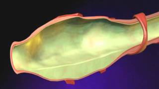 Bronchiectasis Animation  What is Bronchiectasis Videomp4 [upl. by Essined]