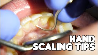 Dental Cleaning  Hand Scaling Tips [upl. by Alyad]