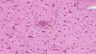 Histopathology Brain Viral encephalitis [upl. by Tahp]