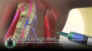 Stellate Ganglion Block Injection [upl. by Nref]