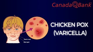 Chicken Pox Varicella [upl. by Minerva776]