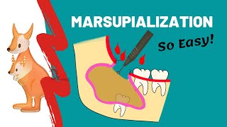 Marsupialization  WHEN WHY amp HOW [upl. by Rehpotsrihc]