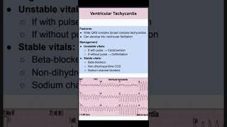 Ventricular Tachycardia [upl. by Kimberly]