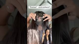 feedshorts psoriasis psoríase dermatite explorarpage autocuidado beleza explore scalp [upl. by Meagher428]