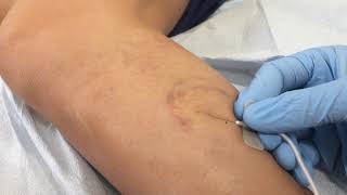 Watch Dr Vein Eraser treat spider veins with foam sclerotherapy [upl. by Ingalls513]