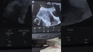 Two different cases of Endometrial Hyperplasia diagnostic ultrasound cases [upl. by Arej569]