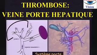 Thrombose de la veine porte hepatique diagnostic imagerie [upl. by Ynnav308]