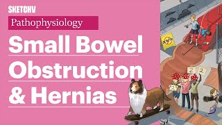 Small Bowel Obstruction SBO Ileus amp Hernia Part 1  Sketchy Medical  USMLE Step 1 [upl. by Igor126]