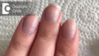 What causes bluish discoloration of nail beds  Dr Rashmi Ravindra [upl. by Enaillil]