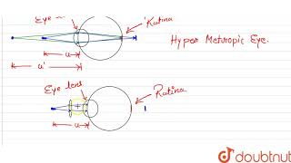 Make a diagram to show how hypermetropia is corrected The near point of a hypermetropic [upl. by Anuahsar61]