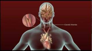 Stroke  Carotid Artery Disease and TIA [upl. by Laureen]