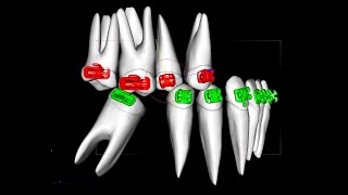 Uprighting molars with the Straight wire system part 1 [upl. by Irotal183]