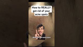 Derm reveals how to ACTUALLY treat acne spots [upl. by Ydner]