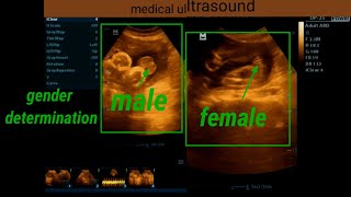 Gender determination by ultrasound [upl. by Isidor]