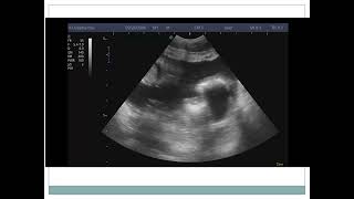 CASE 6 purulent peritonitis due to perforated appendicitis [upl. by Fabiola]